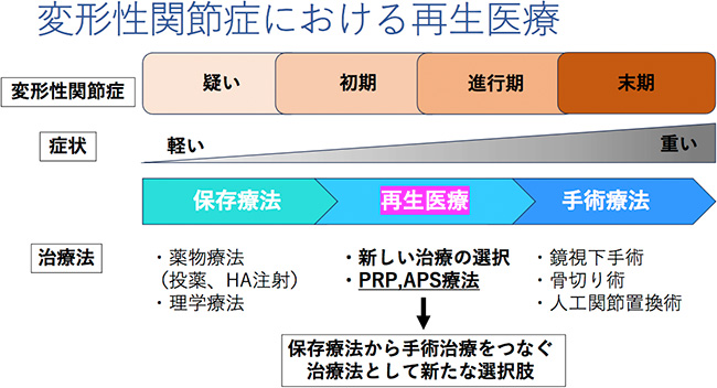 変形性関節症における再生医療