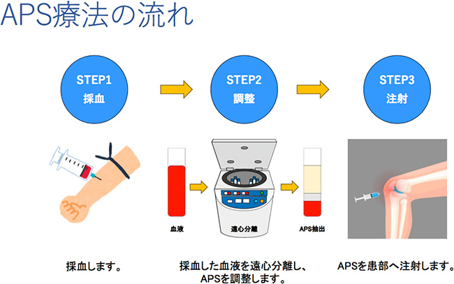 APS療法の流れ