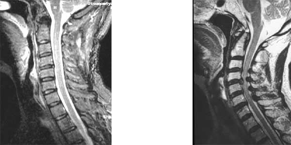 頚椎症性脊髄症 手術