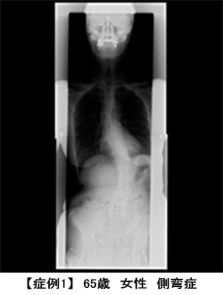 成人脊柱変形症に対する矯正手術