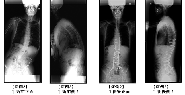 成人脊柱変形症に対する矯正手術