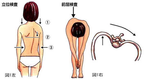 側弯症 チェック