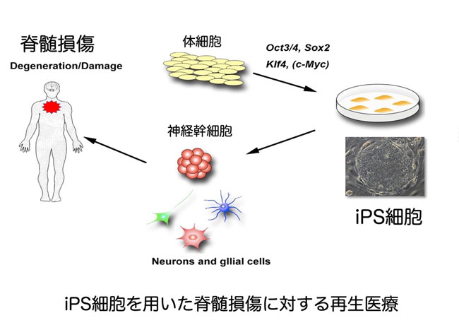 脊髄損傷に対するヒトiPS細胞由来神経幹細胞移植の臨床治験　村山医療センター
