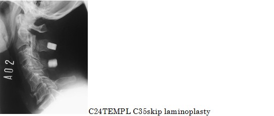 頚椎後縦靭帯骨化症